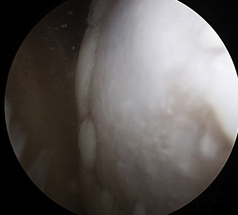 Glenoid OA Arthroscopy